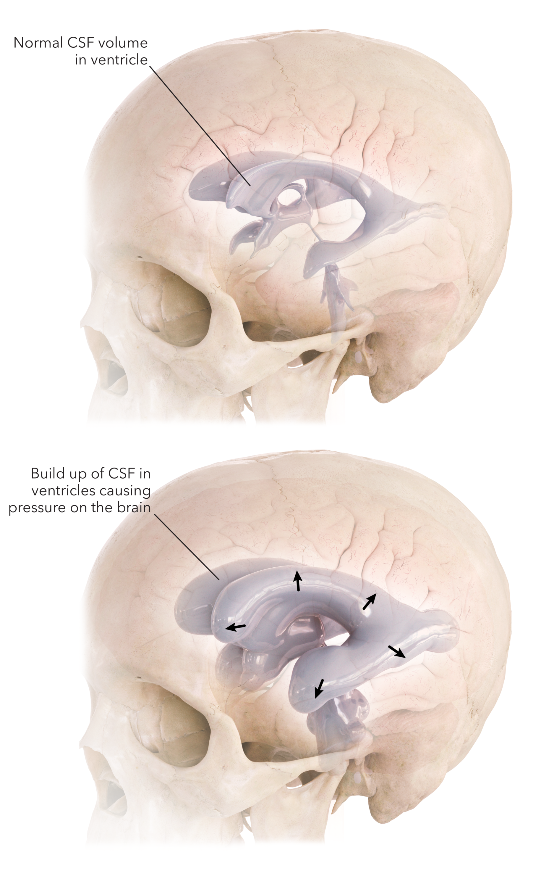 Figure 3: When cerebrospinal fluid (CSF) is unable to drain properly, pressure builds within the ventricles and is exerted on the brain.