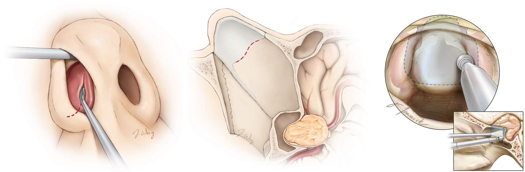 Figure 2. The expanded endonasal transsphenoidal approach allows the surgeon to access the tumor through the nose in a minimally invasive fashion.