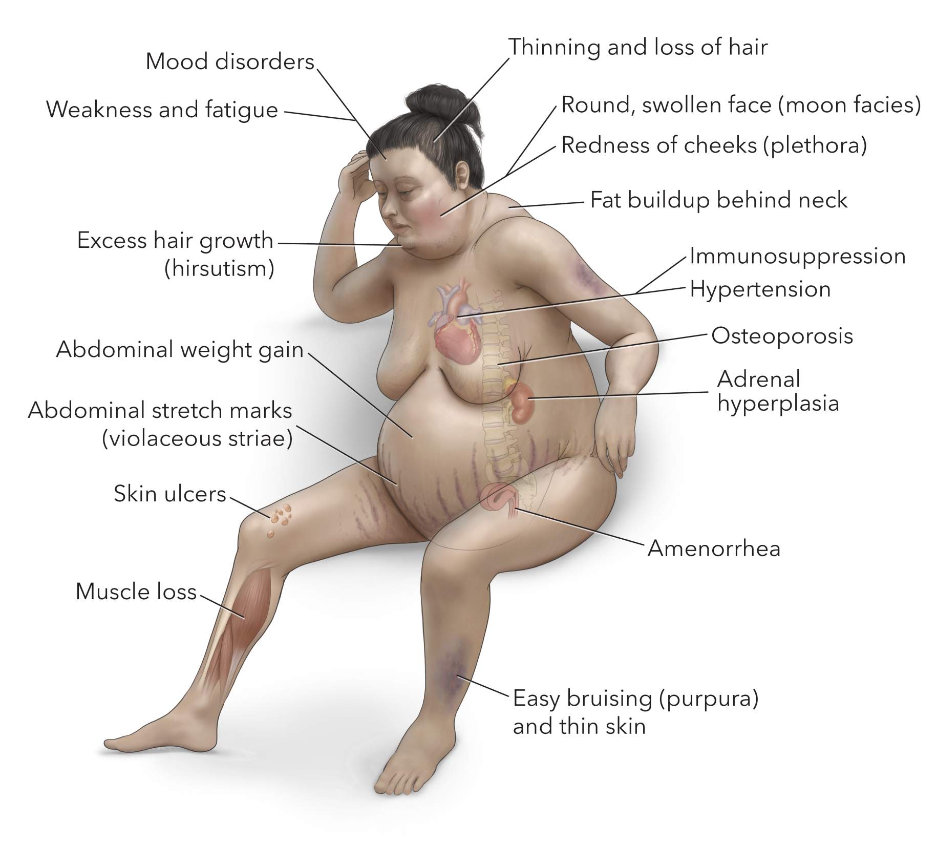 Figure 2. Symptoms of excess cortisol include accumulation of fat behind the neck, abdominal stretch marks, easy bruising, redness of the cheeks, and muscle loss particularly in the arms and legs.