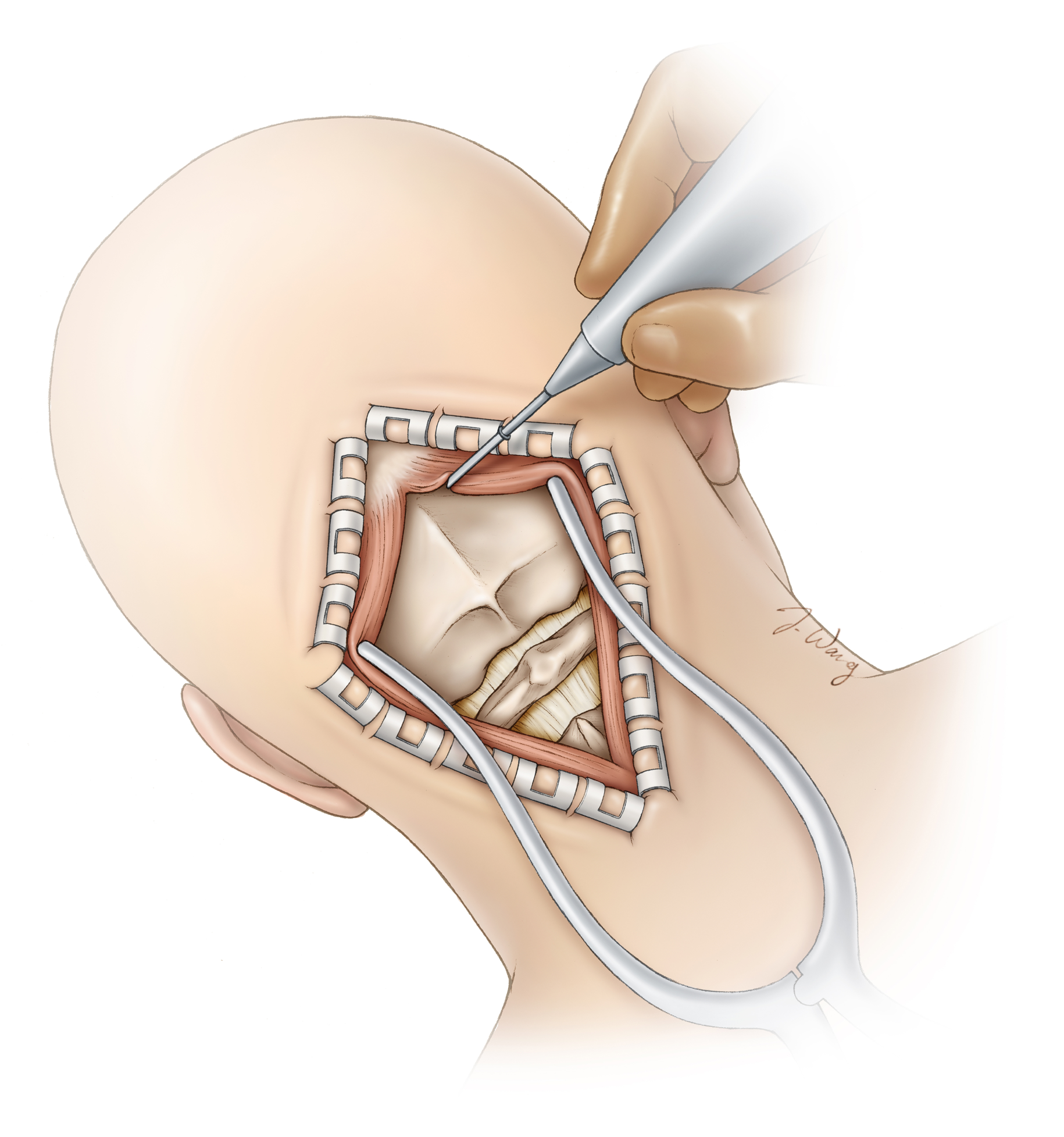 Figure 3: The scalp is retracted with special clips to prevent bleeding. Muscles are parted to reveal the skull bone. This bone will then be removed temporarily to access the brain.