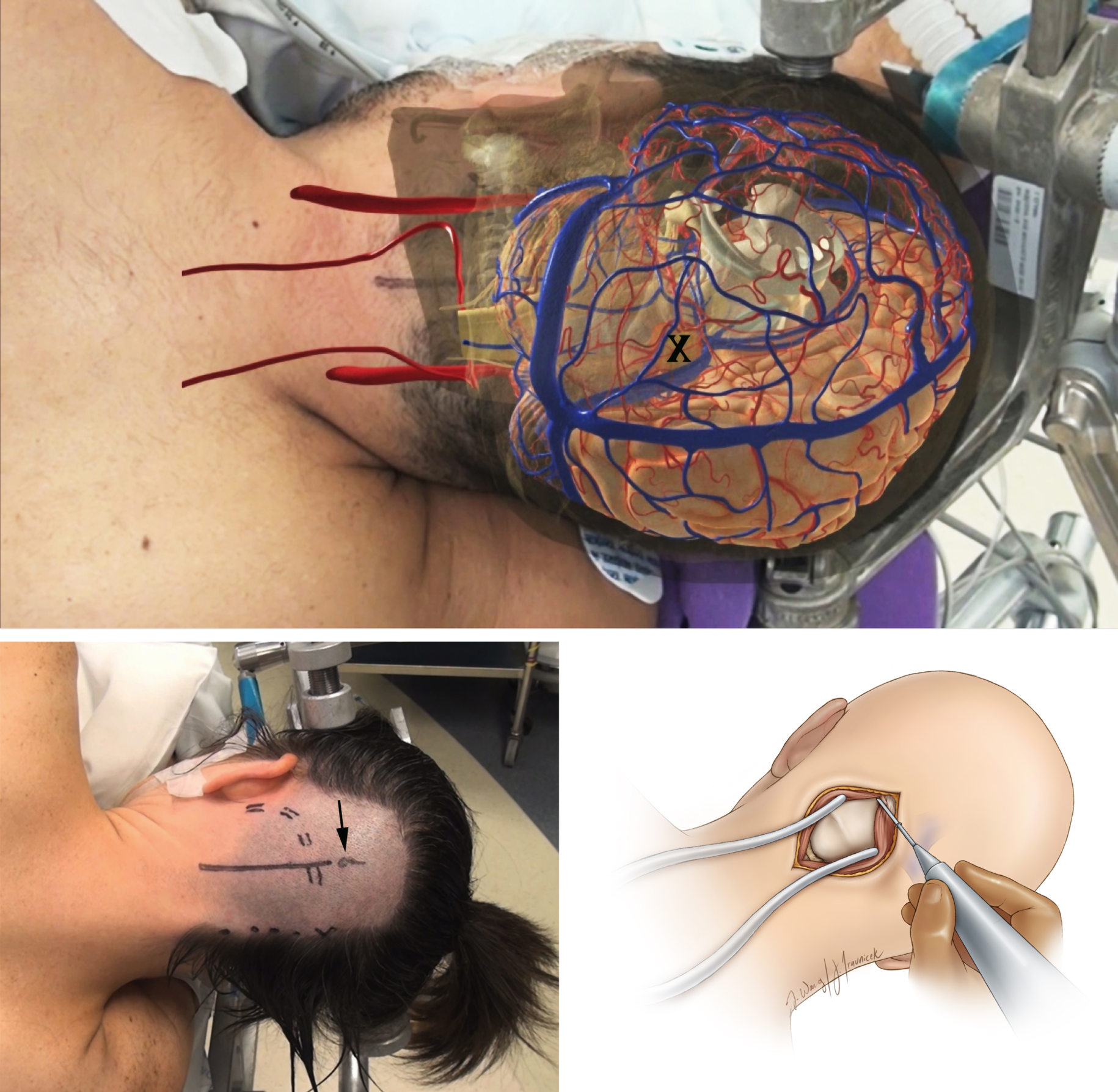 Figure 2: A patient is positioned for surgery. An overlay of the anatomical structures (top) helps the surgeon plan a path to the tumor. The incision path is marked on the scalp (bottom left). Once the scalp is incised, muscles are retracted to expose the skull bone (bottom right).