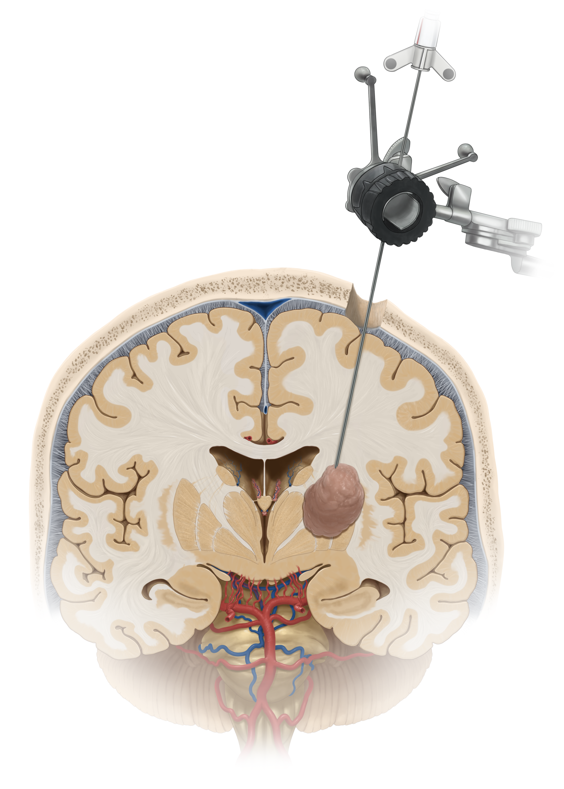 Figure 1. Stereotactic needle biopsy demonstrated through the brain.