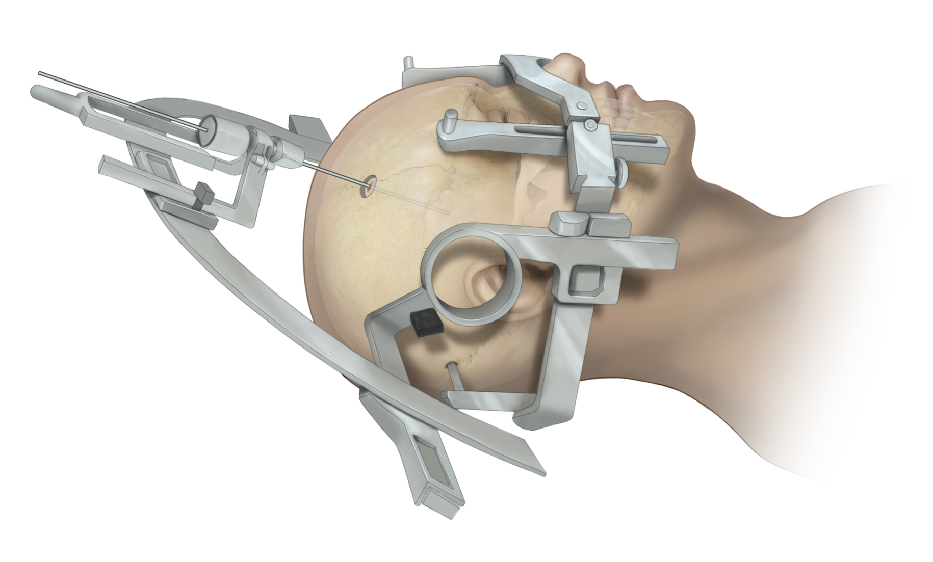Figure 2. Framed stereotactic needle biopsy.
