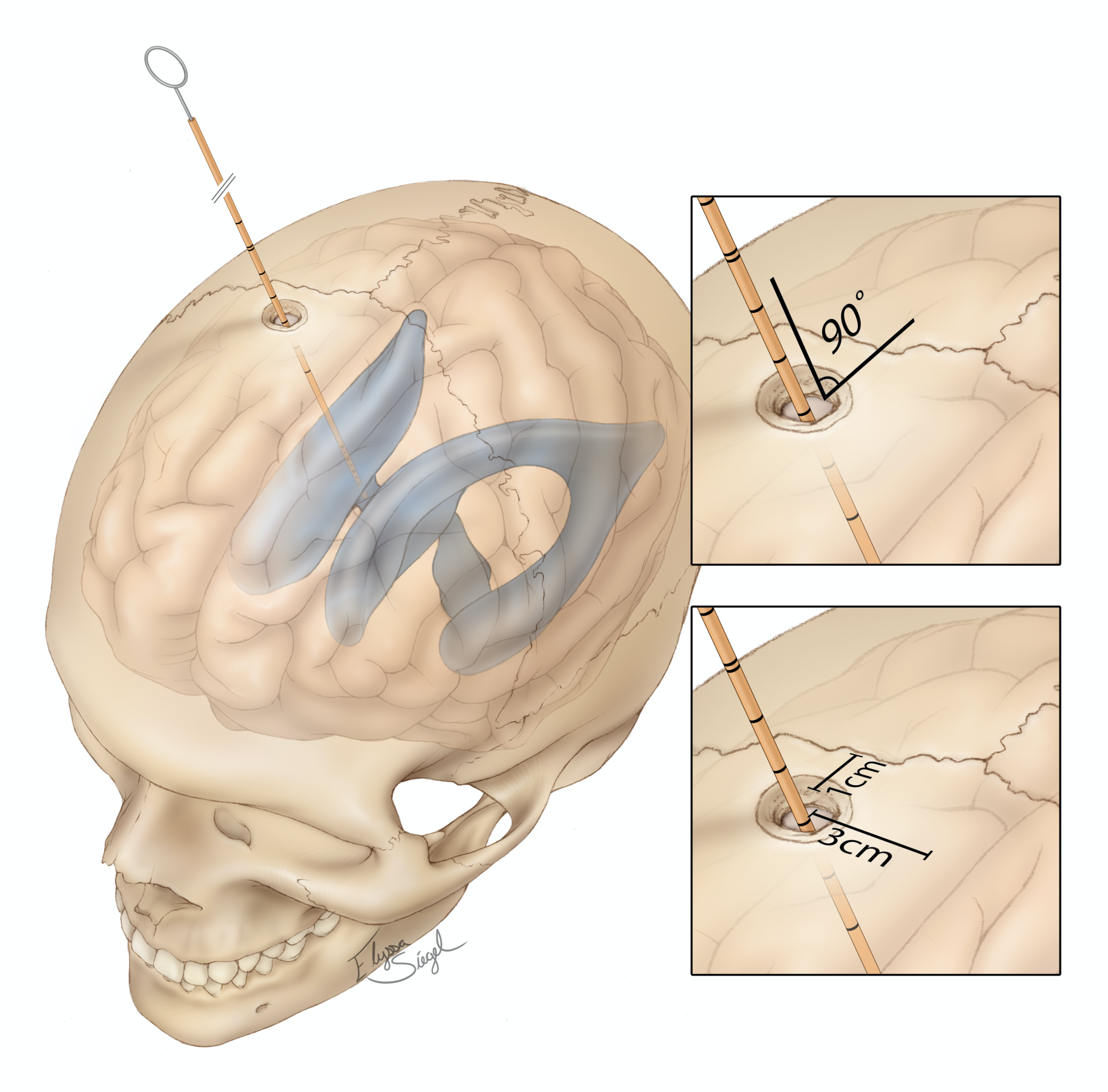 Figure 5: Placement of the catheter into a ventricle of the brain.
